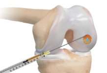 Lutrina Klinik Kaiserslautern: Dr. Wolfgang Franz und seine Knie-Patienten sind von Ergebnissen begeistert – Nur eine OP notwendig